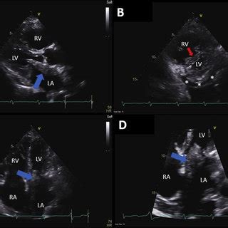 Cardiac Mri Tissue Characterization The Left Atrial Mass Blue Arrows