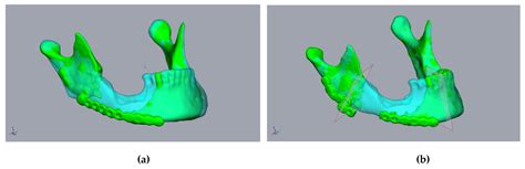 Jpm Free Full Text A Novel Method For Secondary Mandible