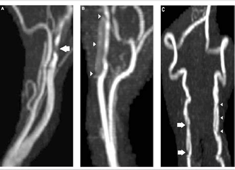 Figure 1 From Bilateral Carotid And Bilateral Vertebral Artery Dissection Following Facial