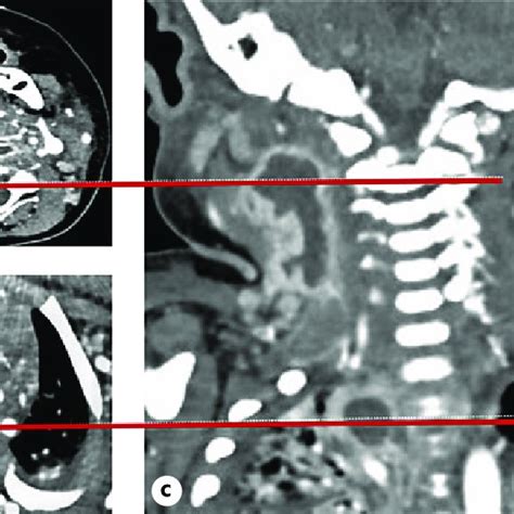 A Contrast Enhanced Ct Of The Neck Axial View B Contrast Enhanced Ct Download Scientific