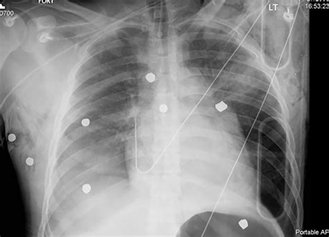 Penetrating Chest Injury 2017 08 03 Ahc Media Relias Media