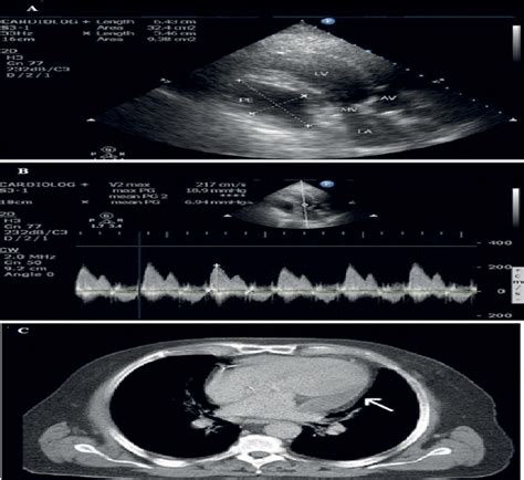 Figure 1 from Transient effusive constrictive pericarditis Geçici