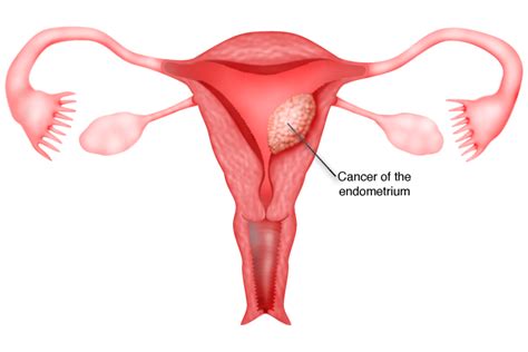 Chapter 12 Cancer Of The Endometrium Melaka Fertility