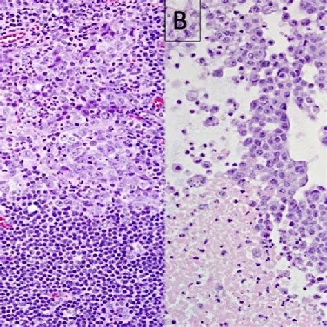 Retroperitoneal lymph node: an open biopsy (a) showed solid nests of ...