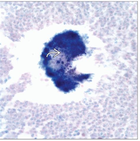 Botryomycosis | Basicmedical Key