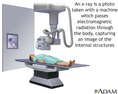 Abdominal x-ray Information | Mount Sinai - New York