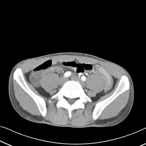 Ulcerative Colitis Image Radiopaedia Org