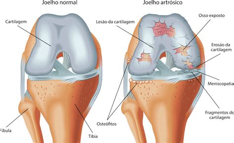 Osteoartrose Do Joelho ICOTE