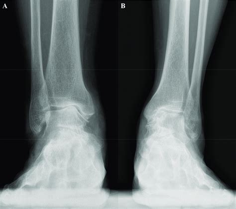 Two Types Of Medial Ankle Osteoarthritis A The Varus Angulation Type