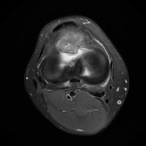 Intracapsular Chondroma Knee Image Radiopaedia Org