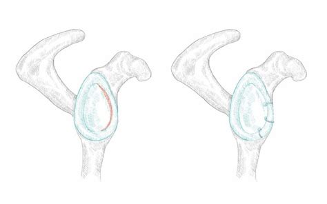 Cirurgia De Reparação Da Luxação Recidivante Do Ombro Ortopedistas