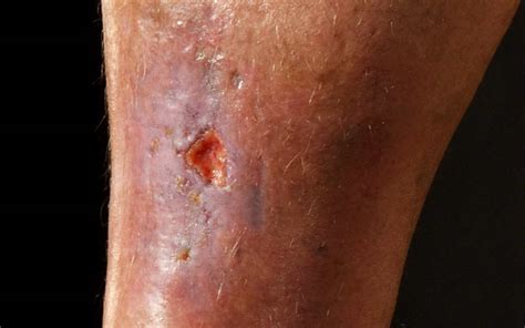 Leg Ulcer Treatment