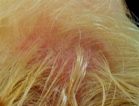 Scalp Burns From Bleach