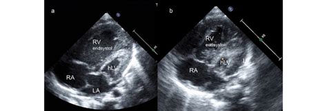 Echocardiographic Four Chamber View Showing The Volumeloaded Rv In