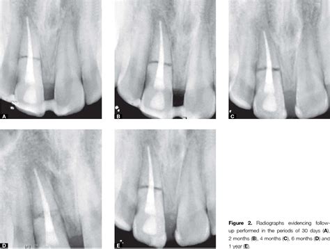 Figure 2 From Horizontal Root Fracture In The Middle Third Case Report Semantic Scholar