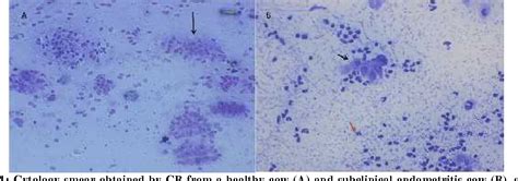 Figure 1 From ASSESSMENT OF THREE DIFFERENT ENDOMETRIAL CYTOLOGICAL