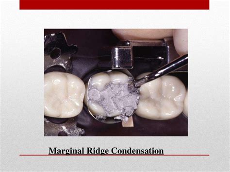 procedure for amalgam restoration