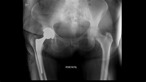 Osteoartritis De Cadera Dr Josué Calderón Gamba