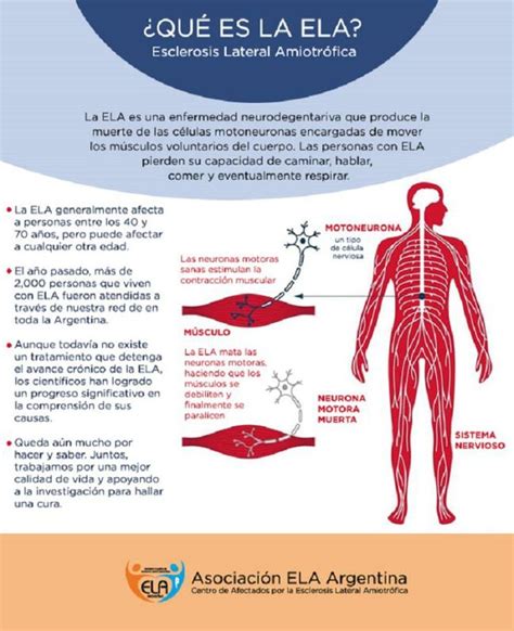 Qué es la Esclerosis Lateral Amiotrófica ELA y cuáles son sus