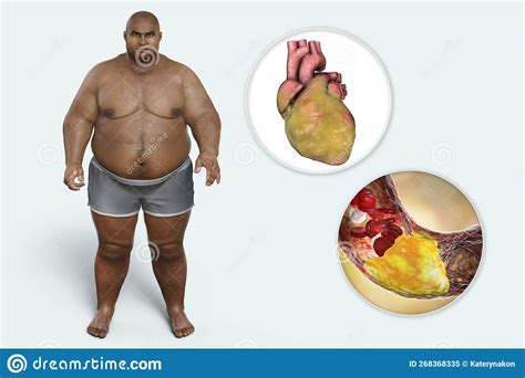 Obesity And Atherosclerosis 3d Illustration Atheromatous Plaque Inside Artery Of Obese Heart