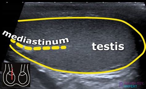 Scrotal ultrasound