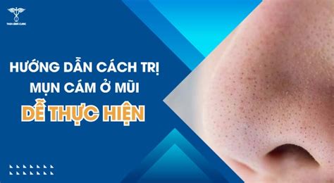 Top 7 Cách Trị Mụn Cám ở Mũi Cằm Tại Nhà Hiệu Quả Nhất Taza Skin Clinic