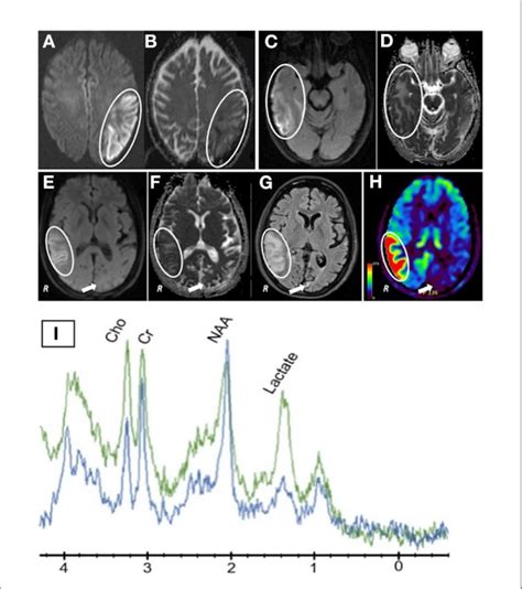 Figure E A Dwi Scan After First Presentation November Rrrr Showing