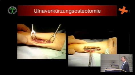 Arthrokopische Und Minimal Invasive Operationen Der Hand Teil 2 YouTube