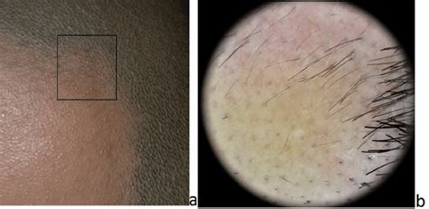 Clinical A And Dermoscopic B Appearance Of Alopecia Areata Download Scientific Diagram