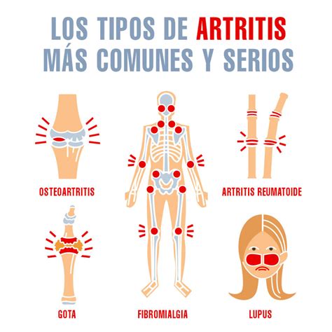 Medidas Que Puede Tomar Para Reducir El Riesgo De Desarrollar Artritis