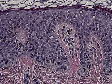 Dysplastic Nevi Dermatologic Clinics