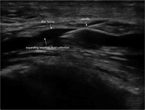 Ultrasound Guided Supra Inguinal Fascia Iliaca Compartment Blocks In