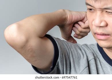 Allergy Rash On Upper Arm Stock Photo 697547761 | Shutterstock