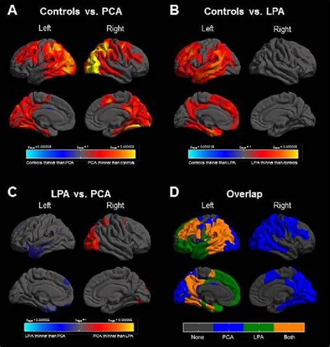 The Language Profile Of Posterior Cortical Atrophy Journal Of