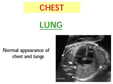 Ultrasonography Of Congenital Fetal Defects