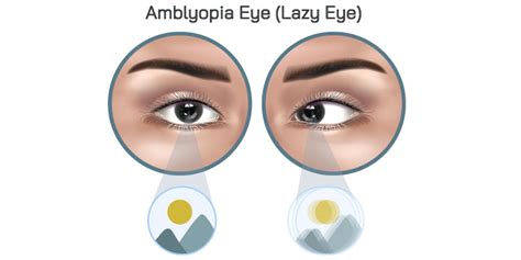 Amblyopia (Lazy Eye) - Symptoms, Causes and Treatment | FYEyes