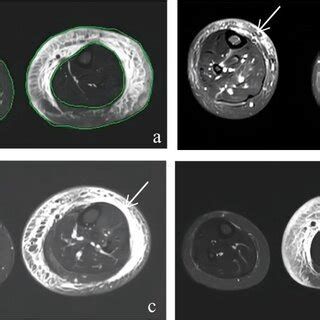 (a) MRI measurement of soft tissue in the calf: the boundary between ...