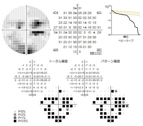 Acute Macular Neuroretinopathy AMN 荻窪駅前眼科白内障手術網膜硝子体手術緑内障手術