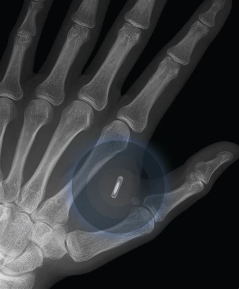 human rfid implants thousands implanted foghorn news