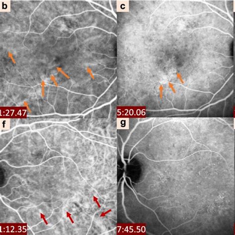 Clinical Characteristics Of Central Serous Chorioretinopathy Detected