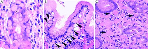 A In Situ Signet Ring Carcinoma Cells Confined Within Basement