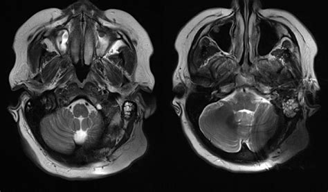 Cochlear Implants & MRI Safety | Blog