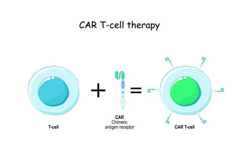 Car T治疗骨髓瘤成功案例全球肿瘤医生网