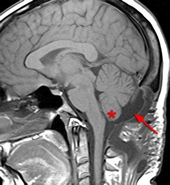 Chiari I Malformation | Radsource