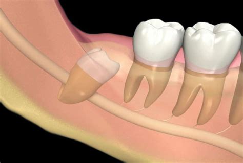 Estrazioni Denti Del Giudizio Dentista Mb Lugano