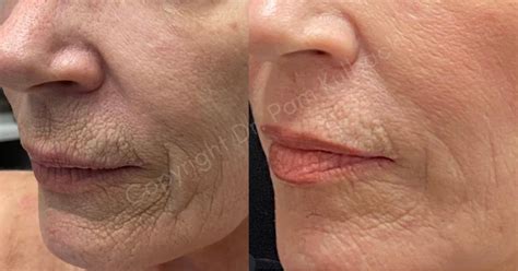 Tetra Co2 Laser And Coolpeel™ The Latest In Laser Skin Resurfacing