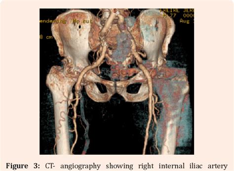 Figure From Compressive Iliac Aneurysm A Rare Case Of Sciatic Nerve