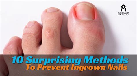 10 Surprising Methods To Prevent Ingrown Nails