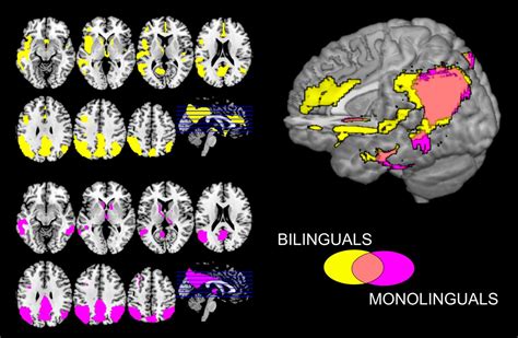 The Impact Of Bilingualism On Brain Reserve And Metabolic Connectivity