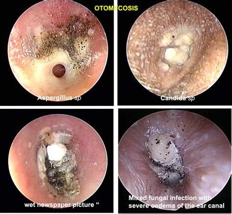 60 Otomycosis Medical Junkies